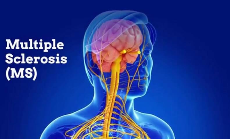 Multiple Sclerosis