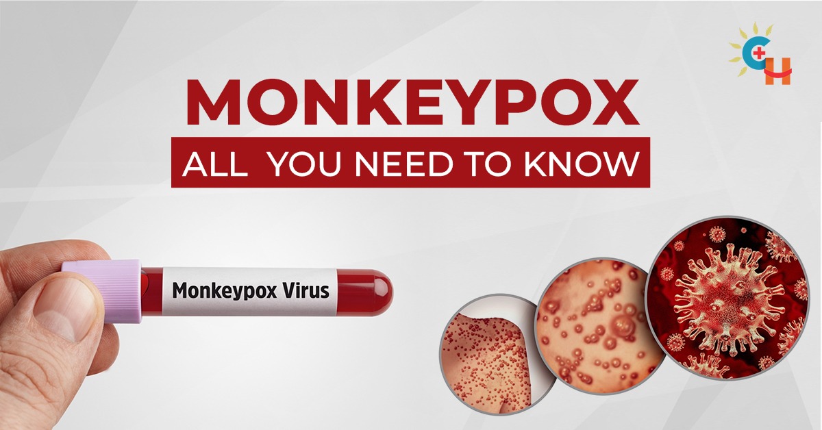 Monkeypox raising concerns in India: All you need to know