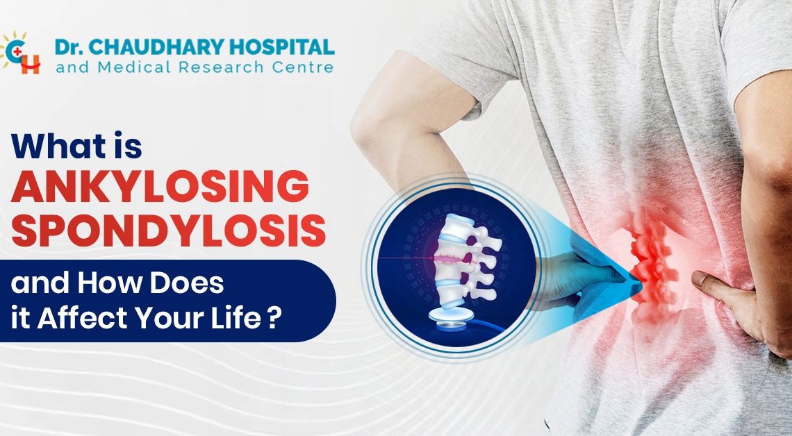 Ankylosing Spondylosis