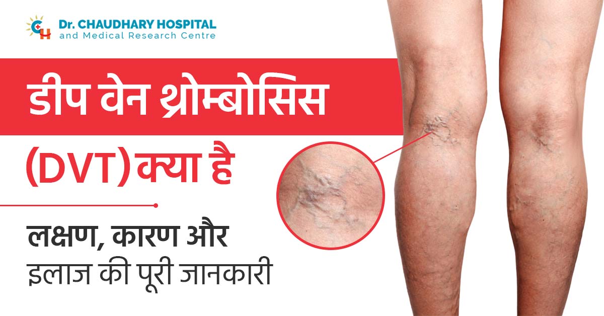डीप वेन थ्रोम्बोसिस (DVT) क्या है? लक्षण, कारण और इलाज की पूरी जानकारी